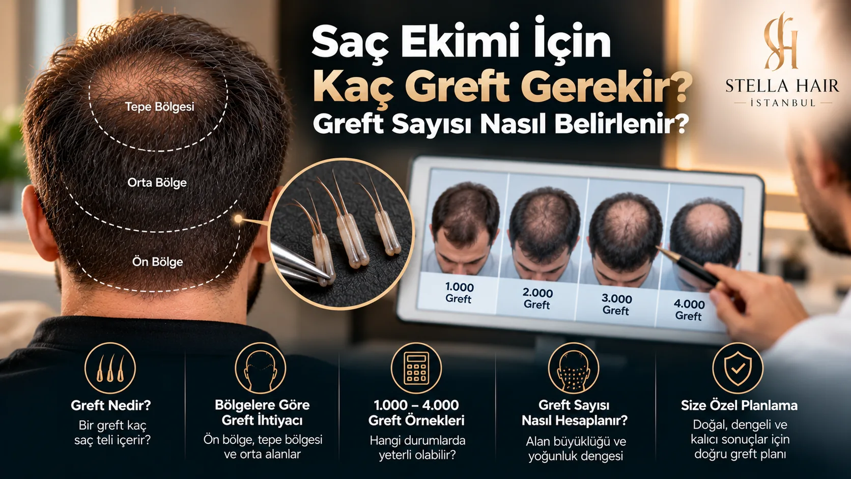 Saç Ekimi İçin Kaç Greft Gerekir ve Greft Sayısı Nasıl Belirlenir?
