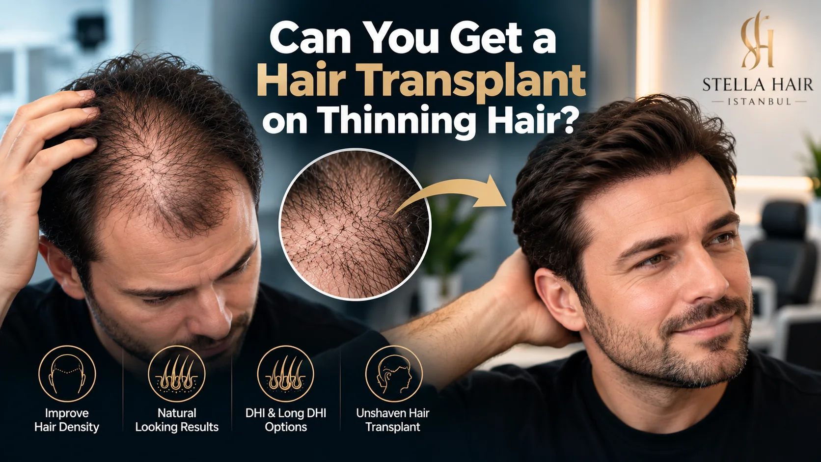 Can You Get a Hair Transplant on Thinning Hair?