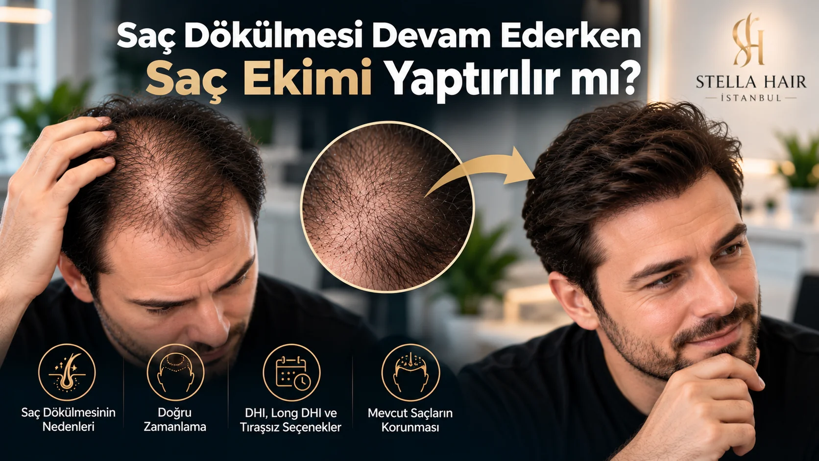 Saç Dökülmesi Devam Ederken Saç Ekimi Yaptırılır mı?