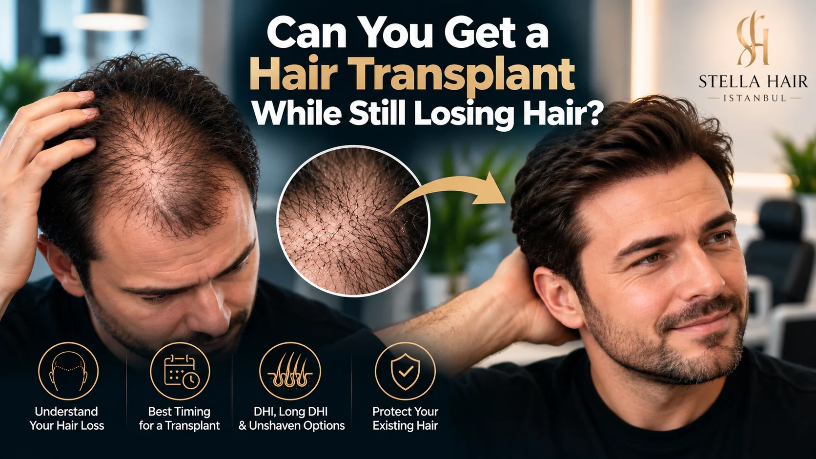 Can You Get a Hair Transplant While Still Losing Hair?