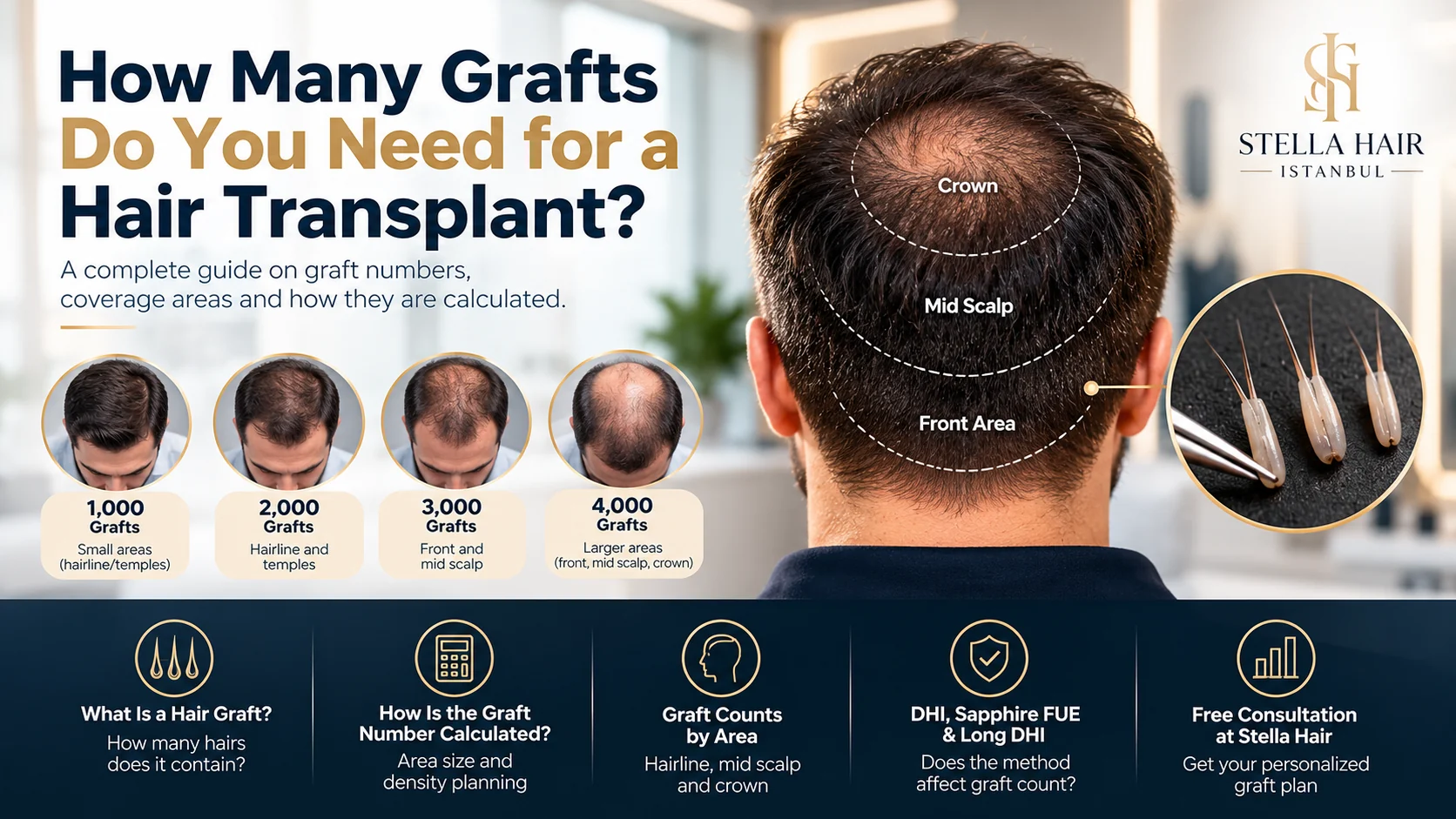 How Many Grafts Do You Need for a Hair Transplant and How Is the Number Calculated?