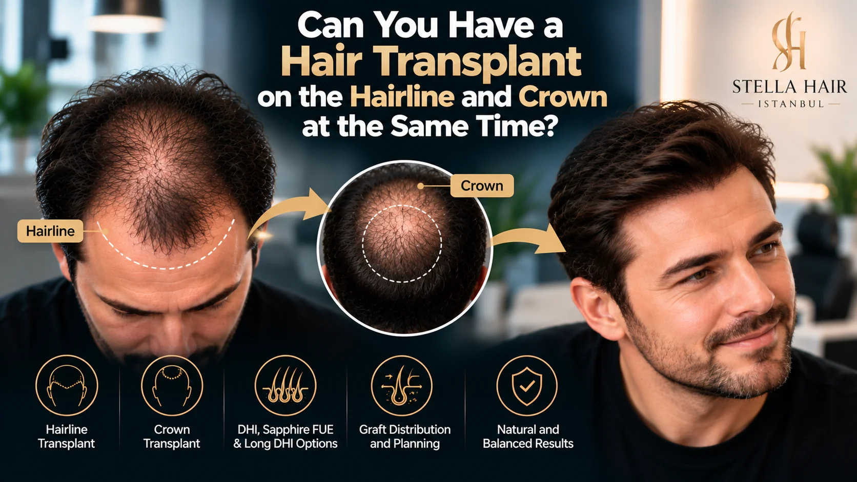 Can You Have a Hair Transplant on the Hairline and Crown at the Same Time?