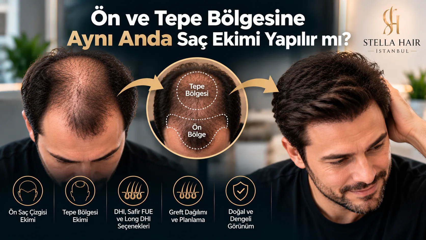 Ön ve Tepe Bölgesine Aynı Anda Saç Ekimi Yapılır mı?