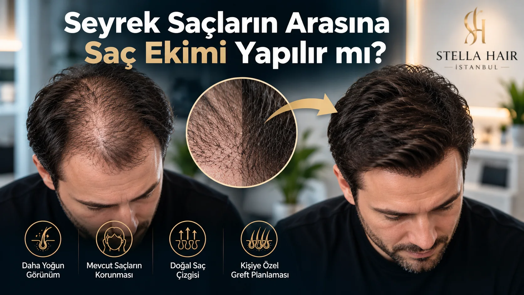 Seyrek Saçların Arasına Saç Ekimi Yapılır mı?