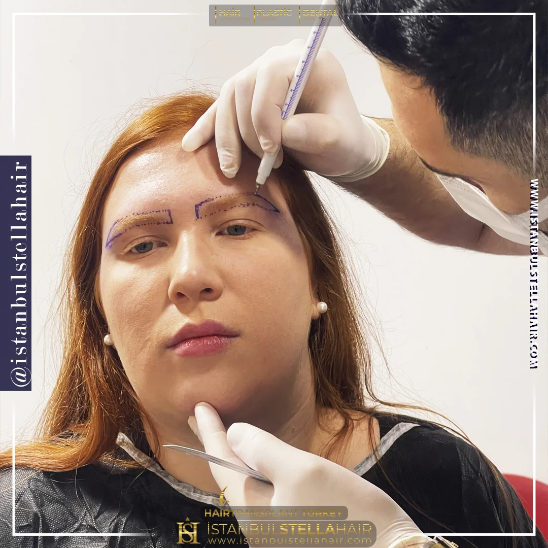 Eyebrow transplant planning photo