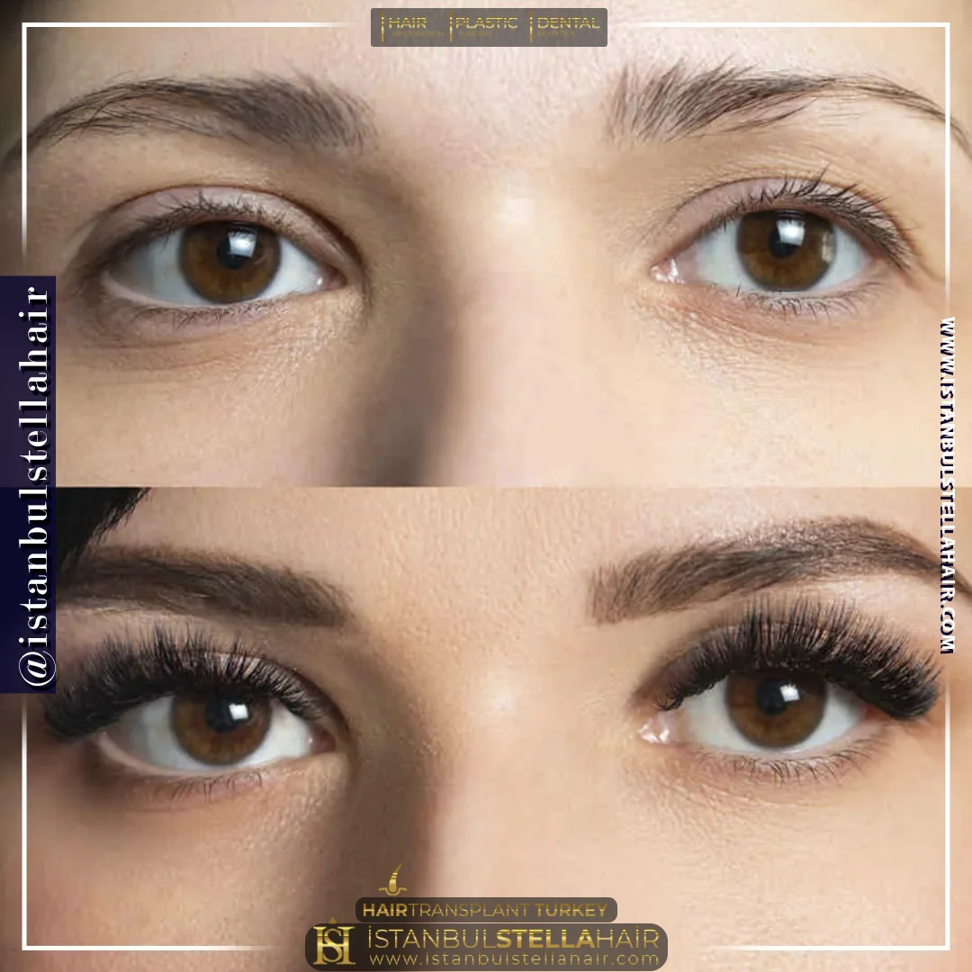 Eyebrows transplant before and after comparison photo 1