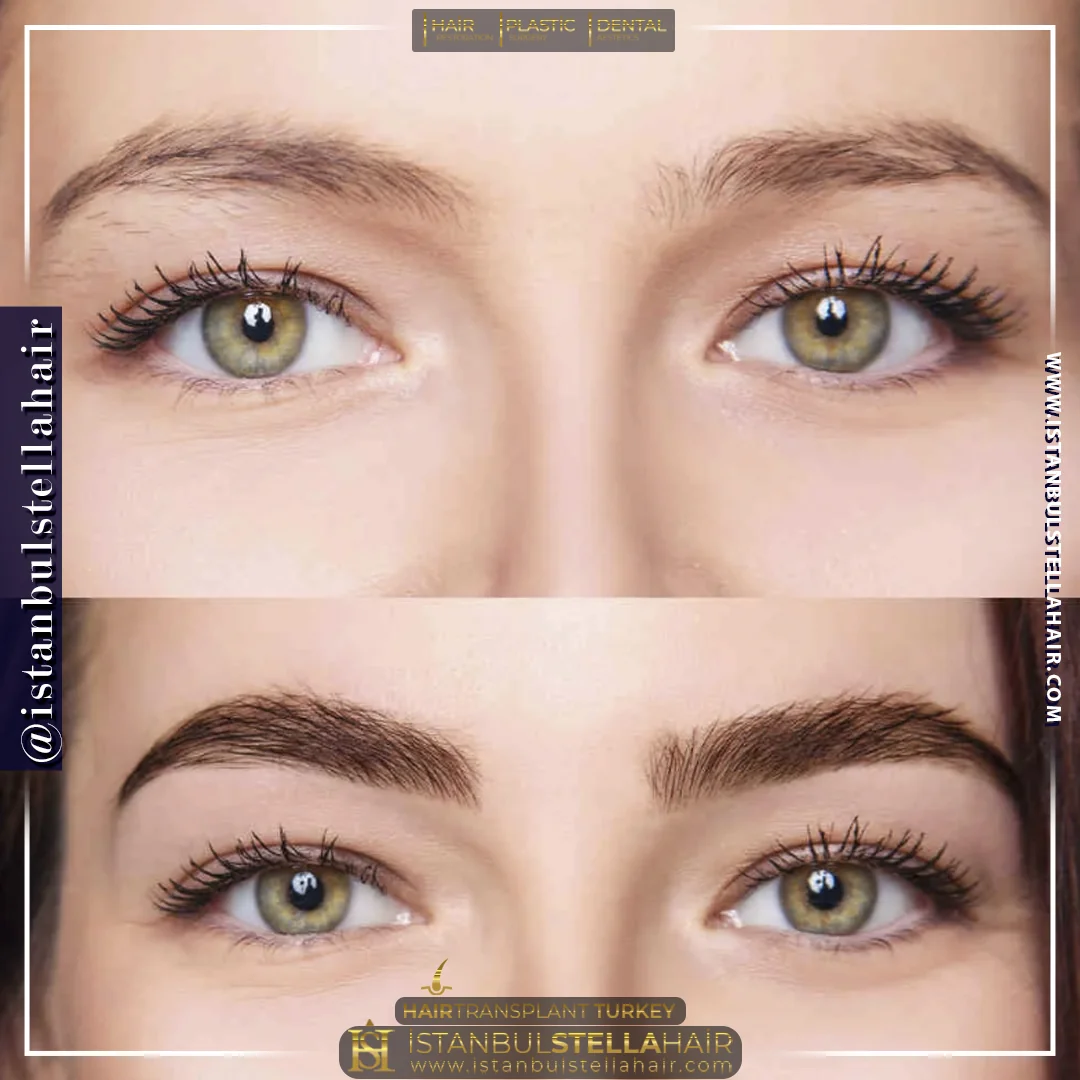 Eyebrows transplant before and after comparison photo 2