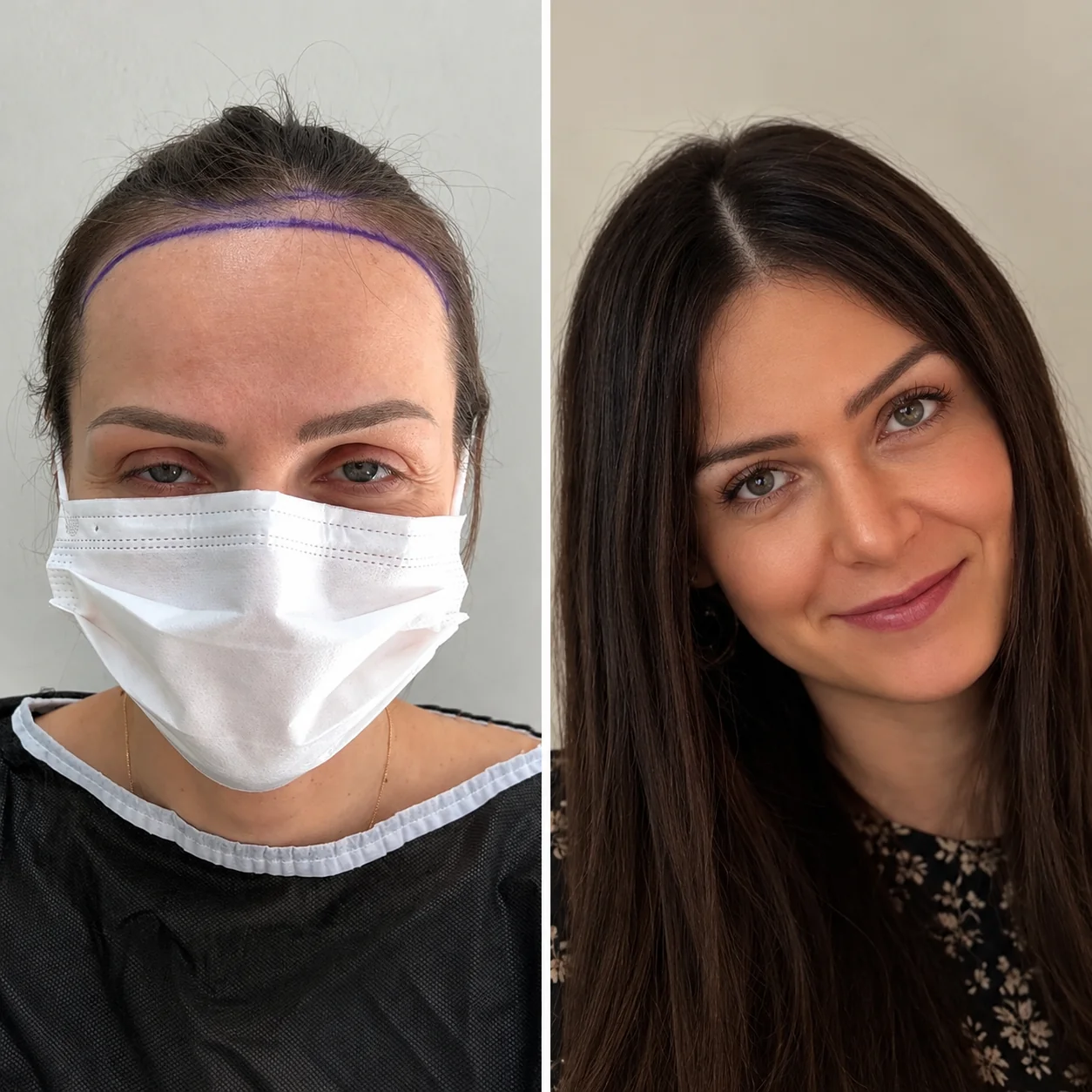 Hair transplant before and after comparison photo 16