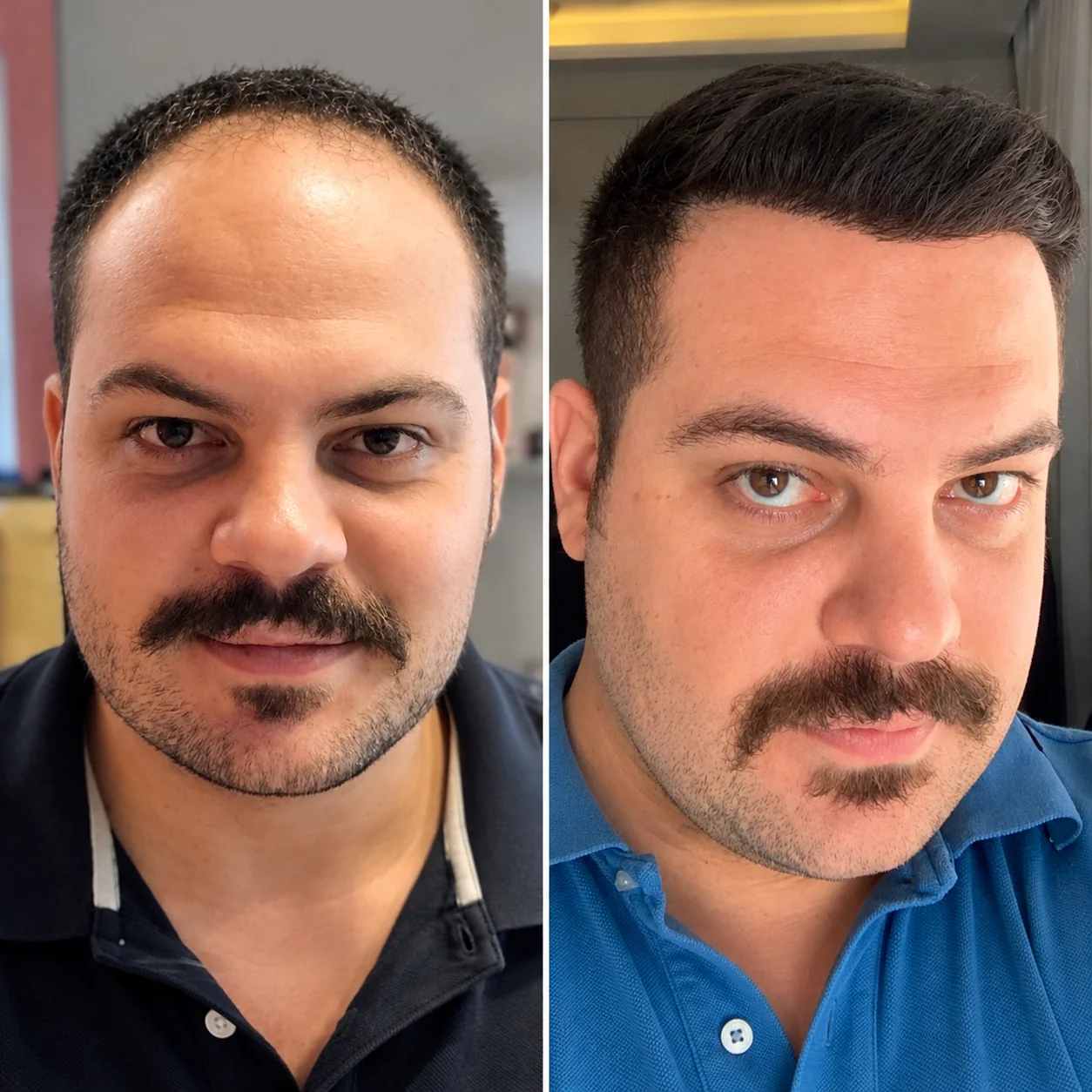 Hair transplant before and after comparison photo 8