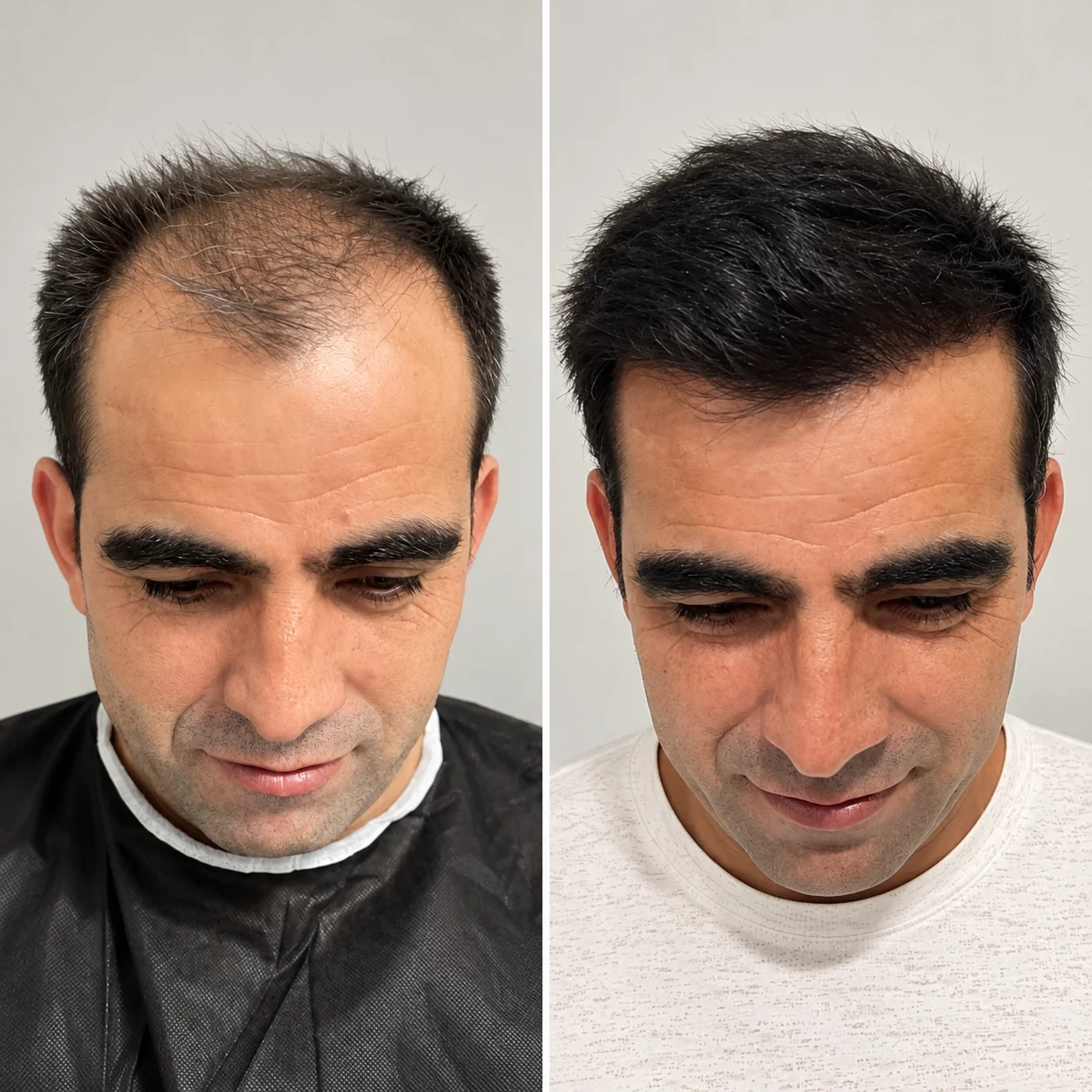 Hair transplant before and after comparison photo 19