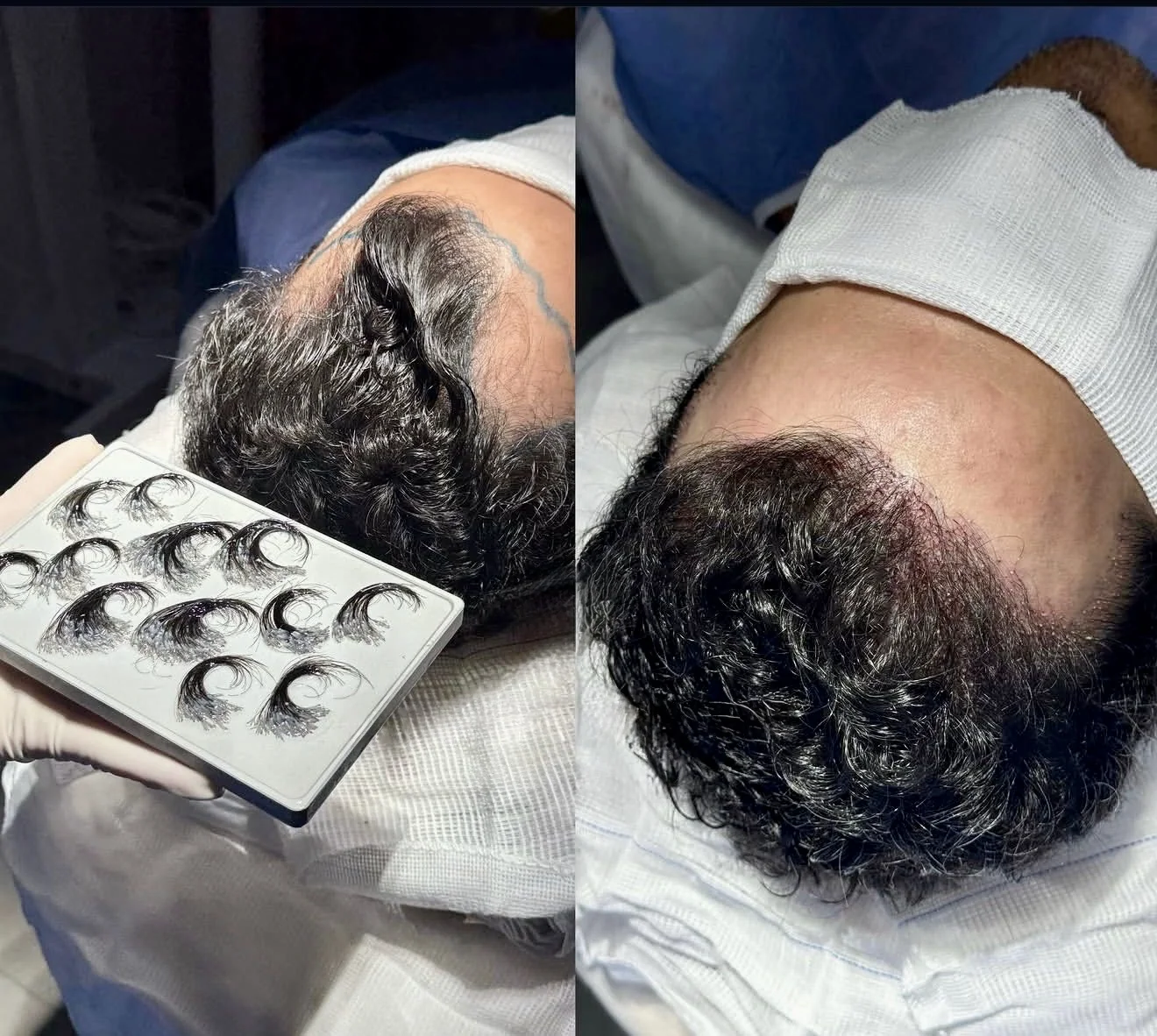 Hair transplant procedure photo