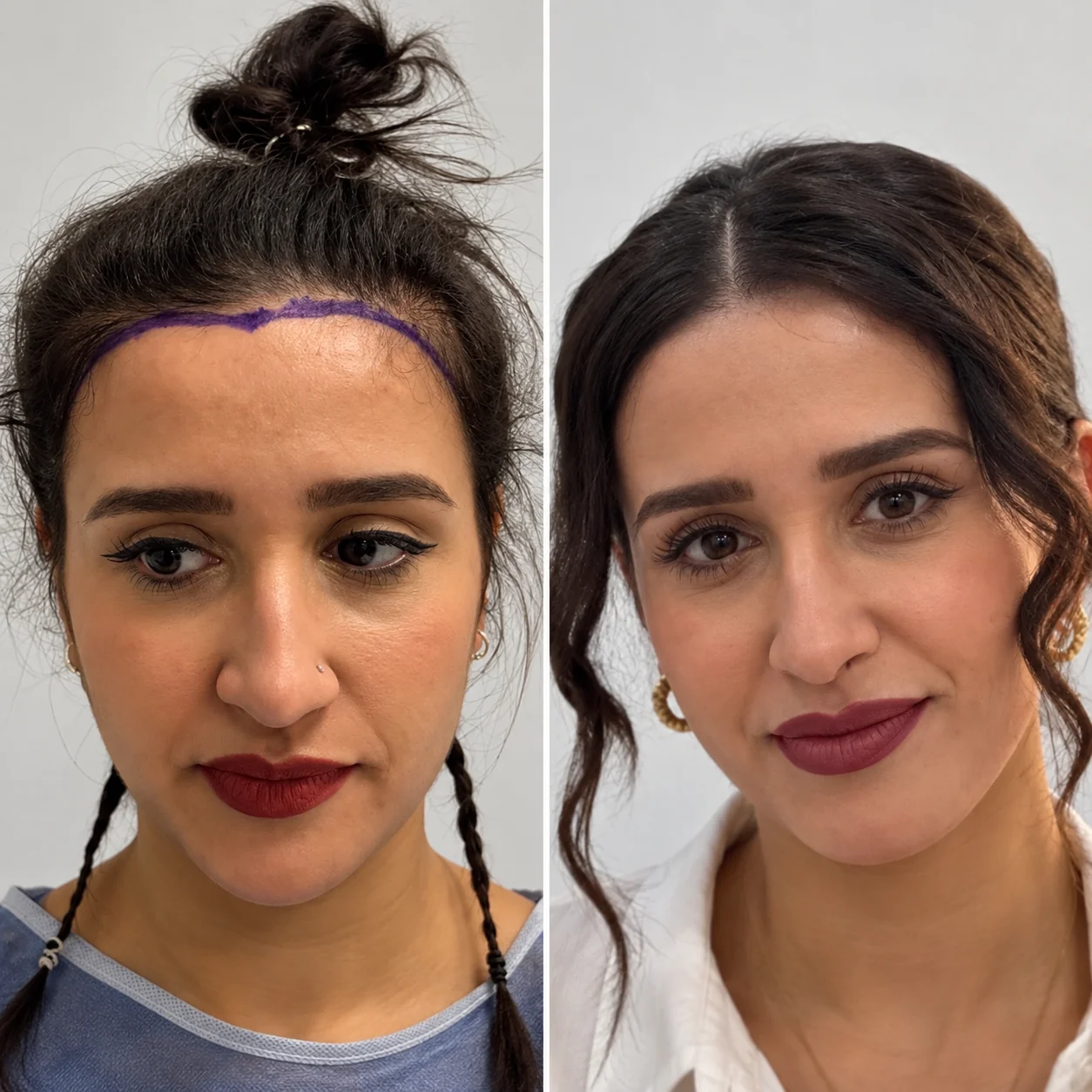 Hair transplant before and after comparison photo 3