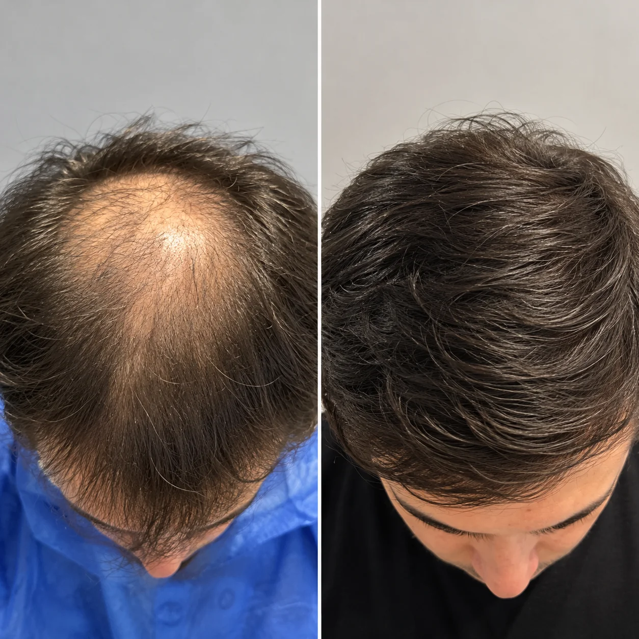 Hair transplant before and after comparison photo 2