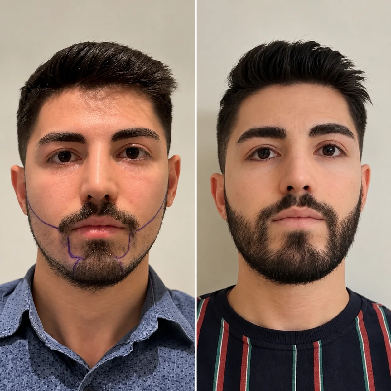 Beard transplant before and after comparison photo 1