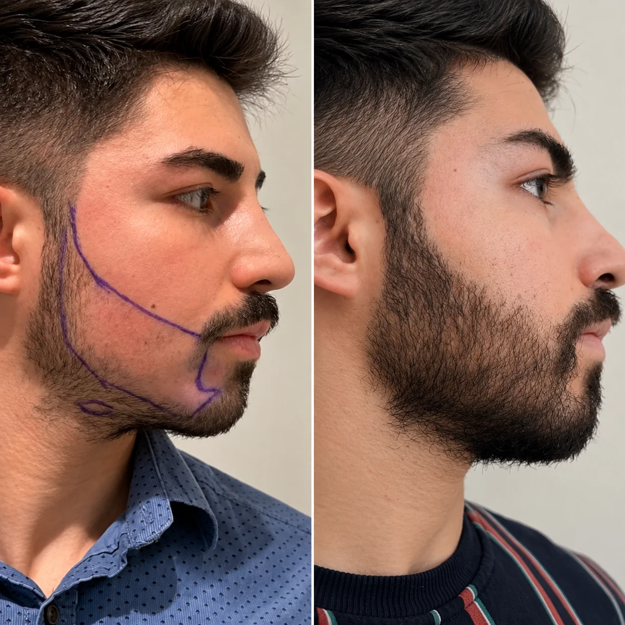 Beard transplant before and after comparison photo 2